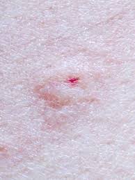 Maybe you would like to learn more about one of these? Common Spider Bite Symptoms Household Wolf Spider Everyday Health