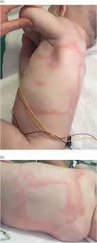 Деран сарафян, дэвид баррет, пол а. Unusual Rash Accompanied By Enterovirus Infection And Human Bocavirus Co Infection In A 9 Week Old Infant In Cologne Germany Semantic Scholar