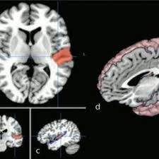 Newer divisions of the auditory cortex are: Anatomical Depiction Of The Primary Auditory Area Ba 41 42 A Download Scientific Diagram