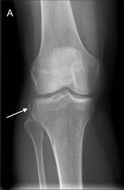 Image result for Fracture XRay