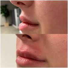 I had been looking into laser hair removal for some time and they had a great deal. Concierge Medical Aesthetics 40 Photos 18 Reviews Medical Spas 2330 E Bidwell St Folsom Ca Phone Number Yelp