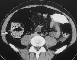 Image result for Neutropenic Colitis