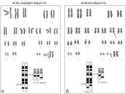 Here, we report a male neonate, with the classical features of emanuel syndrome. Figure 1 A Karyotype And Schematic Ideogram Genereviews Ncbi Bookshelf