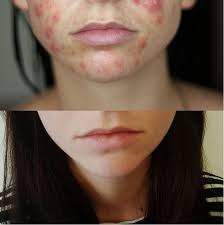 Birth control can be an agent for breakouts or can be used to solve them; Spironolactone Clears Woman S Acne In 4 Months Before And After Photos Allure
