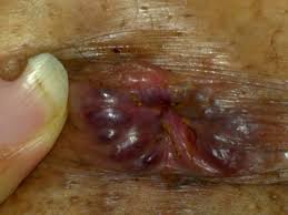 External hemorrhoids à¤¸à¤¾à¤ à¥? à¤?à¤®à¥?à¤? à¤ªà¤°à¤¿à¤£à¤¾à¤®