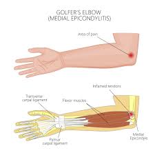 Image result for Epicondyle Injection
