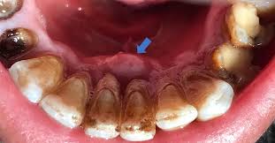 Image result for Periodontal Abscess
