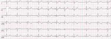 Herzrhythmus Fokus Ekg