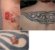 And other than the risk of hepatitis and other infectious diseases, most people think that tattoos are harmless. Melanoma On Tattoos Two Finnish Cases Html Acta Dermato Venereologica