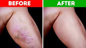 Apple cider vinegar is a natural body cleansing ingredient help to improves your blood circulation. 10 Natural Ways To Get Rid Of Varicose Veins And Increase Blood Flow Youtube