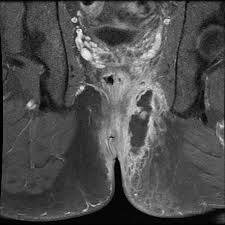 Image result for Ischiorectal Abscess