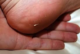 How To Remove A Splinter With Baking Soda Splinter Removal Health Health And Beauty Tips