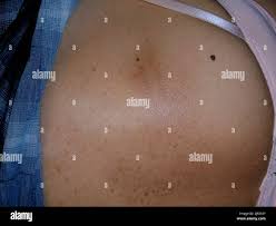 Image result for Notalgia Paresthetica