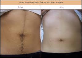 Application of topical antibiotics like neosporin will also help. Laser Hair Removal Before And After Images By Dr Hanna Laser Hair Removal Hair Removal Professional Hairstyles