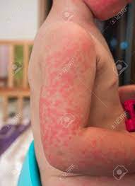 Severe allergic reactions (anaphylaxis) affect breathing and the heart, and can therefore be life threatening. Allergies Pimples On The Baby S Skin Food Allergy Skin Diseases Symptoms Stock Photo Picture And Royalty Free Image Image 130043591