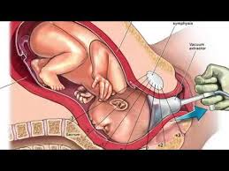 Image result for Forceps Assisted Delivery