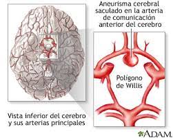 O aneurisma é uma área frágil na parede de um vaso sanguíneo que se torna uma protuberância e pode aumentar de tamanho. Pin En Aneurisma