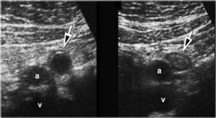 Pin By Ah Ben On Abdominal Radiology Diagnostic Medical Sonography Ultrasound Abdomen