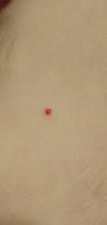 Красная точка на голове - Вопрос дерматологу - 03 Онлайн