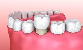 Degenerative dental disease is the most. How Long Does It Take To Get Implant Crowns Smiles By Julia Fort Lauderdale Florida