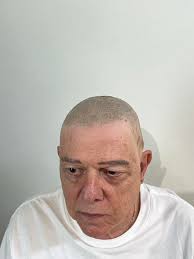 What are the types of hairlines in SMP?