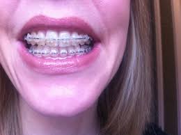If you've ever had braces, or if you have braces right now, then there's a chance that your orthodontist has asked you to wear rubber bands. Braces Clarity Braces At 38