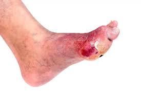 Image result for diabetic toes