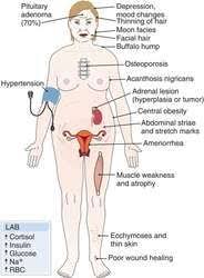 Cushing Sydrome Cushings Cushing Disease Cushings Syndrome