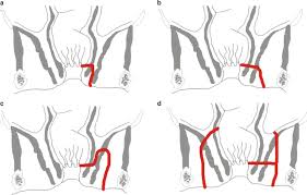 One way a fistula may form is from an abscess (pus in the body). Clinical Assessment And Imaging Modalities Of Fistula In Ano Springerlink