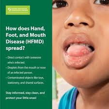 Image result for Hand foot and mouth disease HFMD roof of mouth