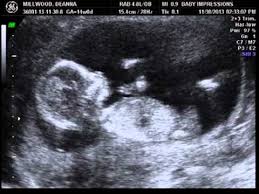 Gender Reveal Ultrasound At 14 Weeks Youtube