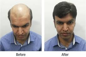The key ingredients being jaborandi,amla,shikakai. Hair Treatment In Mumbai Doctor Heck
