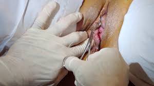Looking for a cyst popping video? Marsupialization Of Bartholin S Gland Cyst Pimple Popping Videos