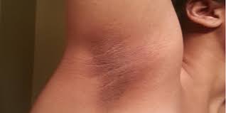 Mari lihat cara selamat dan mudah yang boleh anda amalkan. Tips Berguna Putihkan Celah Peha Yang Hitam