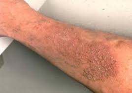 Image result for Lichen Simplex Chronicus