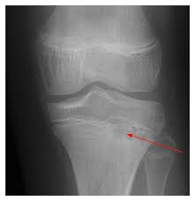 Image result for Osteomyelitis XRay