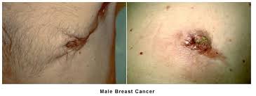 Changes in the shape or size of your breast. Male Breast Cancer And Gynecomastia Breastlink