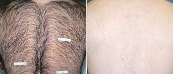 They are often the same effects you might. Laser Hair Removal Dr Julia Sabetta Greenwich Ct Cosmetic Surgeon