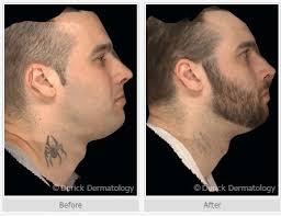 Maybe you would like to learn more about one of these? Laser Tattoo Removal Before And After Winter Park Laser Performs Laser Tattoo Removal In Orlando Fl Laser Tattoo Removal Tattoo Removal Laser Tattoo