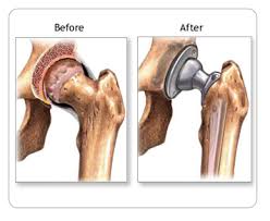 Total Hip Replacement Picture Before And After Hip Arthroplasty Hip Replacement Hip Replacement Surgery Knee Replacement Surgery