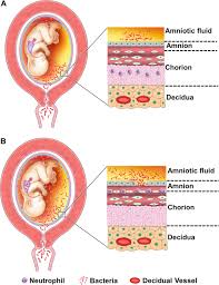 Image result for Chorioamnionitis