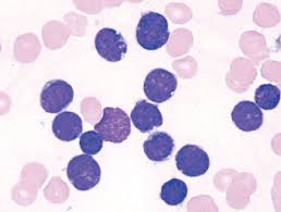Maybe you would like to learn more about one of these? Identifican Causas De La Leucemia Infantil Diagnostico Molecular Mobile Labmedica Es