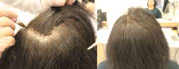 Sac Simulasyonu Yaptiranlar Nelere Dikkat Etmelidir Hairhotel