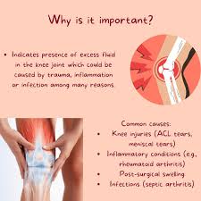 Image result for Ballottable Patella Sign