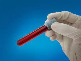 It is a simple, inexpensive and confirmed test for the detection and possibility of cervical cancer. How Simple Blood Tests Could Revolutionize Cancer Treatment Science Smithsonian Magazine
