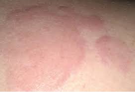 La Urticaria Y El Angioedema La Urticaria Y El Angioedema Libro De Las Enfermedades Alergicas De La Fundacion Bbva