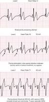 Image result for Transcutaneous Pacing