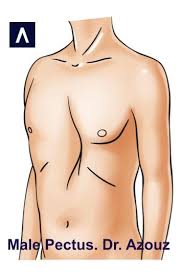 Image result for Pectus Excavatum