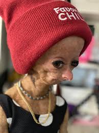 Adalia is so many amazing things, but above all she is our inspiration. Adalia Rose Facebook