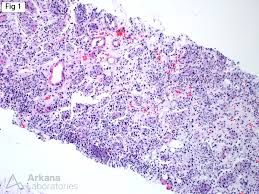 Image result for Acute Pyelonephritis